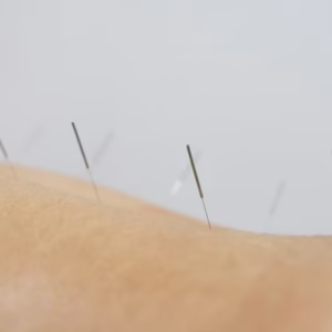Acupuncture in Medicine