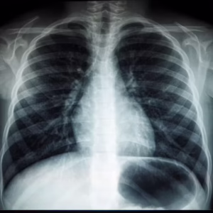 Awareness of Tuberculosis